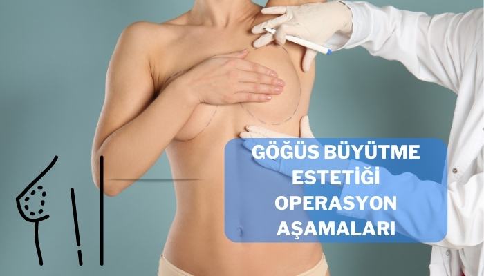 Göğüs Büyütme Estetiği Operasyon Süreci ve Aşamaları