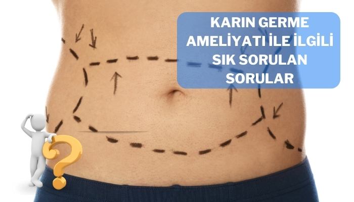 Karın Germe Ameliyatı İle İlgili Sık Sorulan Sorular