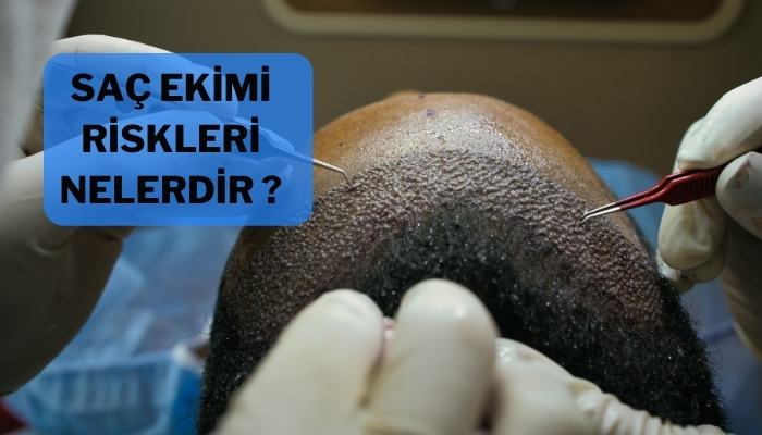 Saç Ekimi Riskleri Nelerdir?