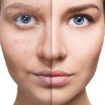 Dermapen İle Leke Tedavisi Nasıl Yapılır? Avantajları Neler?