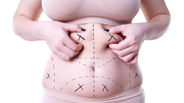 Liposuction Ameliyatı İçin Uygun Adaylar Kimlerdir?
